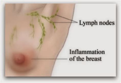 It can occur at any age (and, extremely rarely, in men). Inflammatory Breast Cancer And Symptoms
