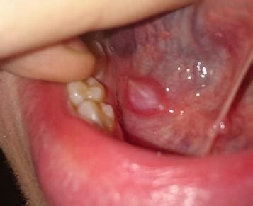 The white or yellow bumps are inflamed papillae (taste buds) that usually develop on your tongue as a result of an injury, infection, or reaction. Bumps Beneath Tongue: Causes and Remedies | New Health Advisor