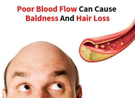 Remedies for increasing blood flow in scalp. Poor Blood Flow Can Cause Baldness And Hair Loss - Hair ...