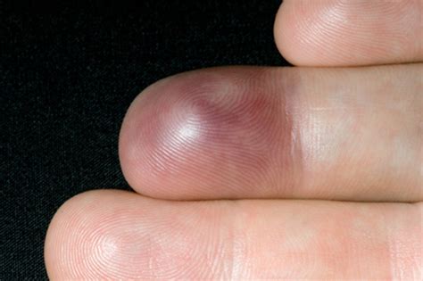 An unusual finger injury | The BMJ