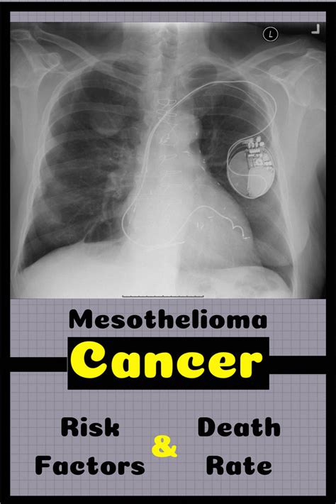 Maybe you would like to learn more about one of these? Pin on Mesothelioma