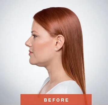 Our burlington medspa is located across from the burlington mall in the same plaza as del frisco's grill. Burlington MA Kybella Before and After Photos - Cambridge ...