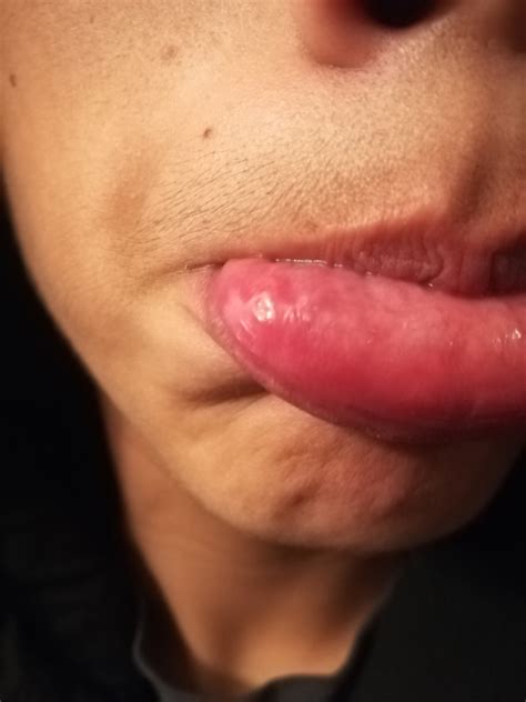 This article covers examination also known as a canker sore, this is a small to medium, round ulcer. Do I have oral cancer? Help! | Cancer | Forums | Patient