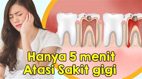 Kerusakan gigi atau gigi berlubang bisa membuat anda sakit gigi. Luar Biasa, Cara Cepat Meredakan Nyeri Sakit Gigi - YouTube