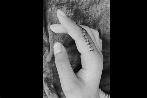 He didn't do the palm job technique. Liza Soberano says injured finger would 'never function ...