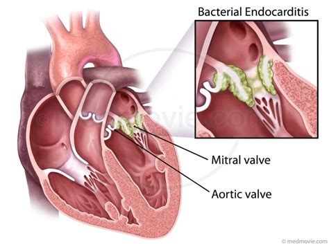 Fatal myocarditis during a viral dengue 1 infection in neiva, huila colombia. خطر اندوکاریت در بیماران مبتلا به بیماری‌های دریچه‌ای قلب ...