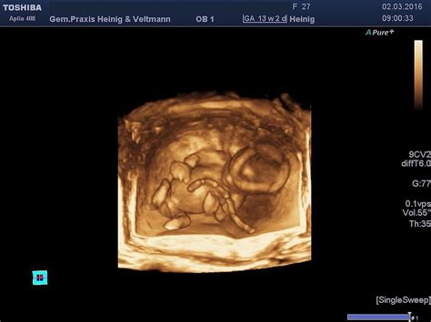 Ab wann ist das geschlecht überhaupt erkennbar? 20 ssw geschlecht. Bin in der 20 ssw, wie sicher ist die ...