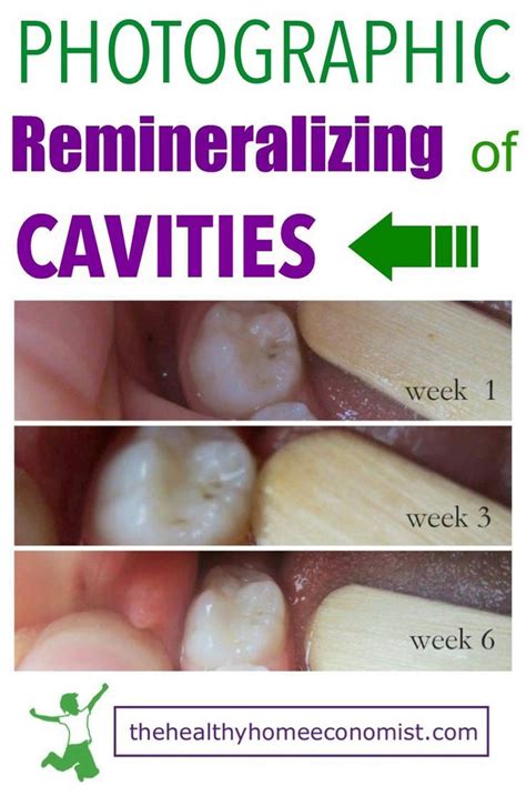 Maybe you would like to learn more about one of these? Do you have cavities but aren't able to go to the dentist ...