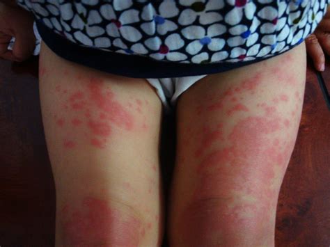 It may result in small blisters in groups often called cold sores or fever blisters or may just cause a sore throat. Global Skin Atlas - Diagnosis Detail