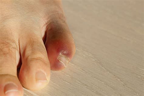 Stubbing your fingers can immediate treatment. Broken Toe Stock Photos, Pictures & Royalty-Free Images ...