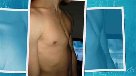 Pectus carinatum is almost always treated with a brace, and not with surgery. pectus carinatum brace - DIY - YouTube