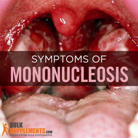 Mononucleosis (usually uncountable, plural mononucleoses). Mononucleosis: Transmission, Symptoms & Treatment