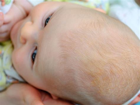 Check spelling or type a new query. Baby's dry scalp: Treatments and causes