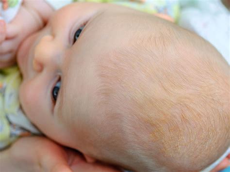 Wash the baby's hair with a mild baby shampoo. Baby's dry scalp: Treatments and causes