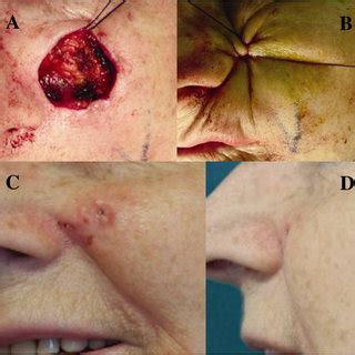 While, conclusion is to explain these numbers based on my theory. (PDF) A simple technique for the excision of cutaneous ...