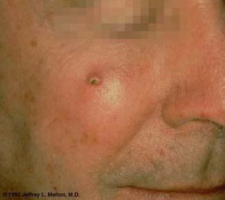 When caught promptly, almost all squamous cell carcinomas (sccs) of the skin can be successfully treated. Squamous Cell Carcinoma of the Cheek