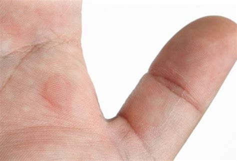 Blisters caused by medical conditions, such as allergic eczema and dyshidrosis, may require treatment. Slideshow: Teen Guy Locker Room Gross-Outs