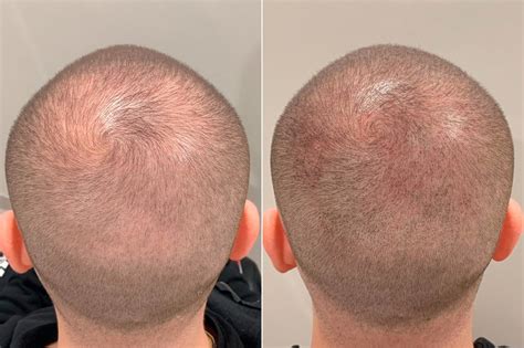 Scalp Micropigmentation Photos - Hair Restoration | Miami ...