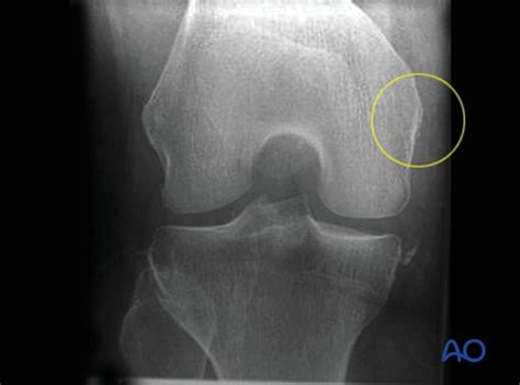 Most of the cases of pellegrini stieda lesions are not symptomatic, and pellegrini stieda syndrome is said to exist when the lesion becomes symptomatic i.e. ORIF - lag screws for Extraarticular fracture, avulsion