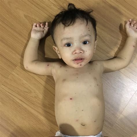 Review the symptoms of chickenpox, a viral infection that is becoming less common because most children now receive the chickenpox vaccine. ily's ♥: Fathan, Chicken Pox dan Cuti Kuarantin