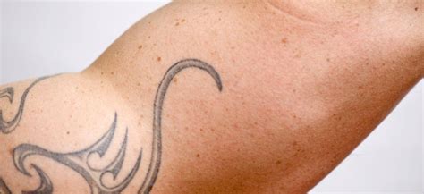 There is no scientific evidence to support. Does Laser Tattoo Removal Cause Skin Cancer? Premium ...