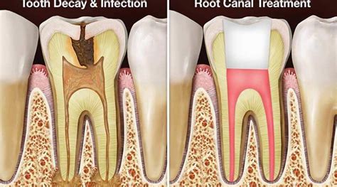 Learn how careplus dental plans provide root canal insurance savings for those with or without existing dental insurance. Root Canal Therapy | Galt Dental Care
