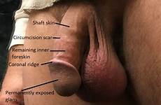 penis foreskin circumcised circumcision anatomy scar perfect does inner circumcisions bdsmlr