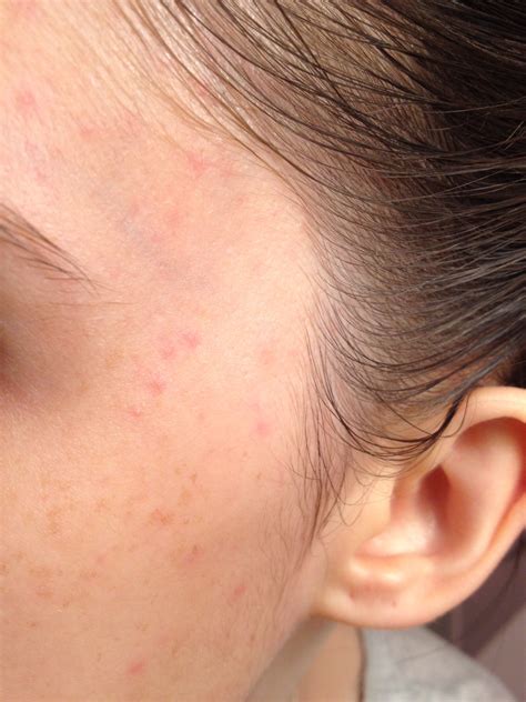 Allergic Reaction? - Beauty Insider Community