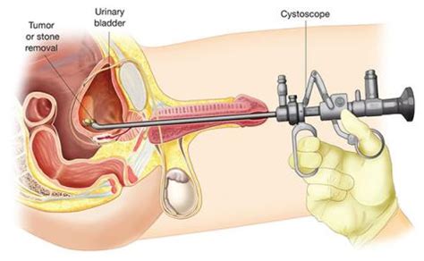 They can be composed of different types of minerals and other substances, but for our purposes we will (as an aside: St George Urology | Lithopaxy (removal of bladder stones)