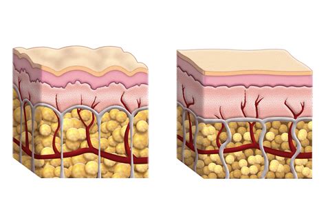 Cellulite is the herniation of subcutaneous fat within fibrous connective tissue that manifests as skin dimpling and nodularity, often on the pelvic region (specifically the buttocks), lower limbs, and abdomen. La Cellulite