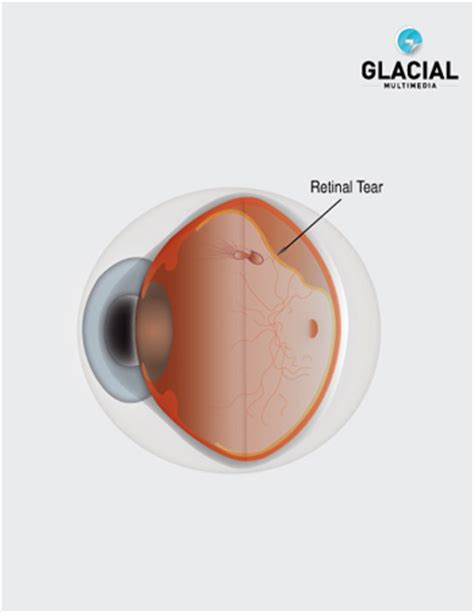 Retinal tear, which may be caused by vitreous traction, and results in vitreous fluid accumulation. Little Rock Laser Treatment Conway | Cabot AR Retinal ...