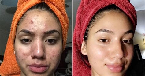 8 produk skincare yang ampuh untuk menghilangkan bekas jerawat lama rekomendasi beauty blogger via ds mybest. Cara Menghilangkan Bekas Jerawat Dengan Cepat Dalam 1 Hari ...