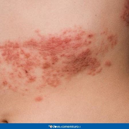 Fuoco di Sant'Antonio (Herpes Zoster): durata, cause ...