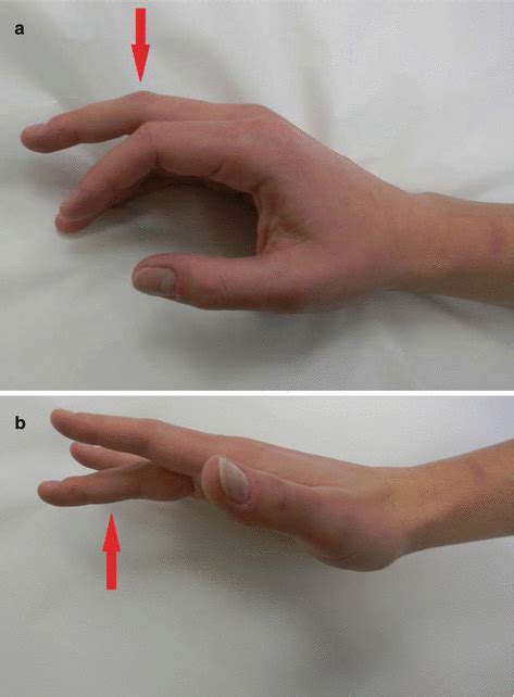Meaning of jersey finger medical term. The Fingers | Musculoskeletal Key