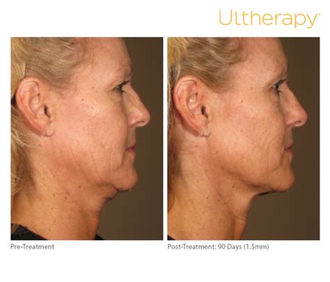 800 east broward blvd, suite 103 fort lauderdale, fl 33301. Non-Surgical Treatment for Turkey Neck - Ultherapy