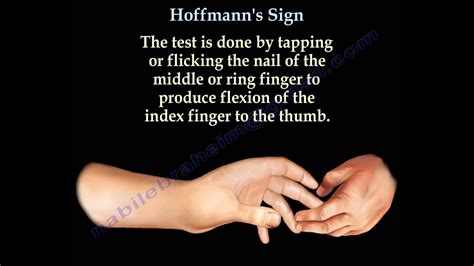 These include the plantar response in the lower extremity and a positive hoffmann's sign in the hand. Hoffmann's Sign - Everything You Need To Know - Dr. Nabil ...