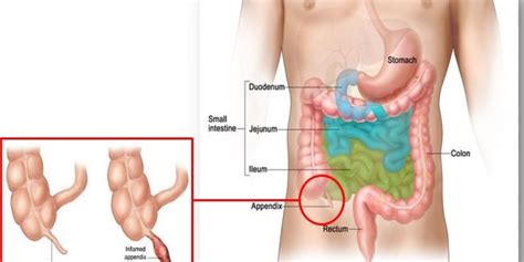 Assalamualaikum, doc, ik wil vragen over postoperatieve blindedarmontsteking, ik heb al 4 weken geleden een appendicitisoperatie ondergaan, de hechtingen zijn ook droog en goed, ik heb ook. Acute Appendicitis - PORTAL MyHEALTH