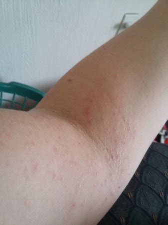 I can believe that it is heat rash on my abdomen because it is under the skin but the raised bumps of different sizes concerned me. Weird red spots on my inner elbow - BabyCenter