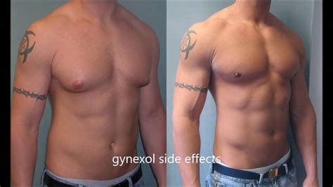 You cant get rid of gyno without surgery if it was pubertal gyno. Gynexol : Best Gynecomastia Treatment Cream for Man Boobs!