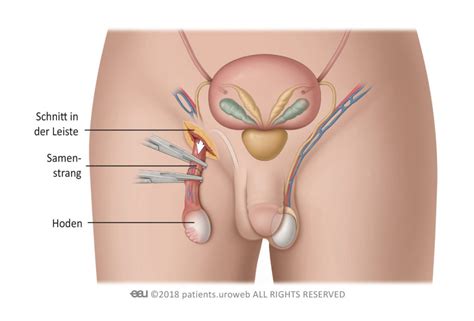 Bleeding vascular complications are a major preventable cause of. Treatment testicular cancer - PI