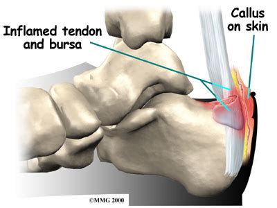 A full range of orthopedic services, from diagnosis to full recovery. Tendinite de Calcêneo: O Que É e Como Tratar | Saúde ...