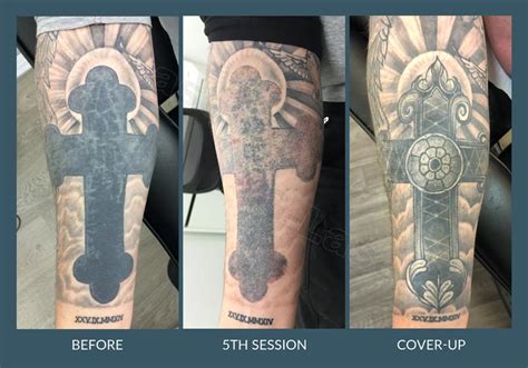 Laser tattoo removal from ethos spa is exactly what you need. Laser Tattoo Removal in Leicester - G-Lasers