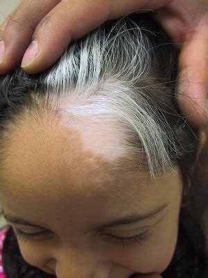 Content the myth what does affect hair los Does Vitiligo Lead to Hair Loss? - NaturWarriors