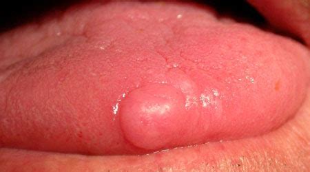 It often causes changes in patches of skin, such as thick growths or. How Mouth Cancer Start? The Beginning Of Mouth Cancer ...