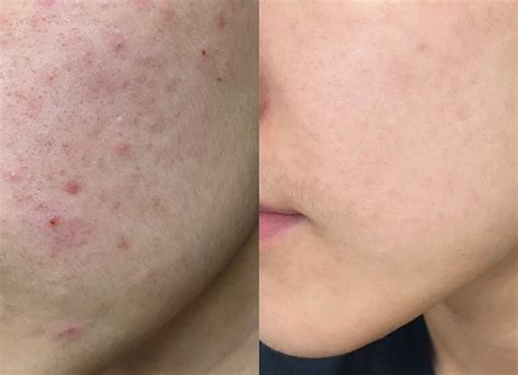 When it comes to acne scars — especially difficult to treat indented or raised ones — the best offense is a good defense. Niacid serum for acne scars: What you need to know - YOU ...