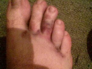 This is why you really don't appreciate its contribution until you injure it. Broken toe healing time | General center | SteadyHealth.com