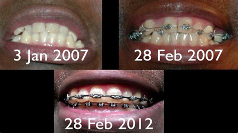 Although everyone is different, most people experience some pain for a few days when they first get braces and after brace tightening. Five Years in Braces - YouTube