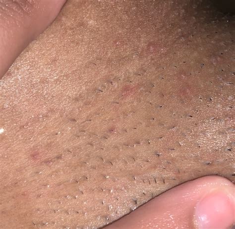 Oral herpes involves the face or mouth. I've been worried to death idk what to do | Genital Herpes Simplex | Forums | Patient
