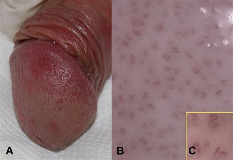 Because inflammation often is accompanied by swelling; Videodermatoscopy enhances diagnostic capability in ...