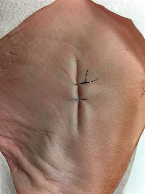 The running horizontal mattress suture is used for skin eversion. The Inverting Horizontal Mattress Suture - Closing the Gap